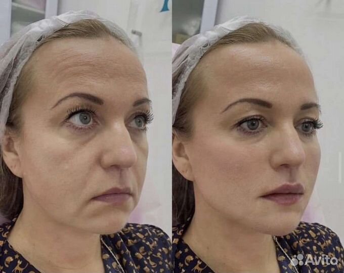 Аппаратное Омоложение лица