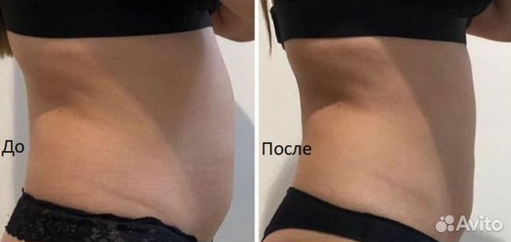 Аппаратный массаж коррекция фигуры