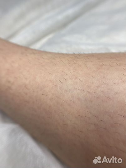 Электроэпиляция