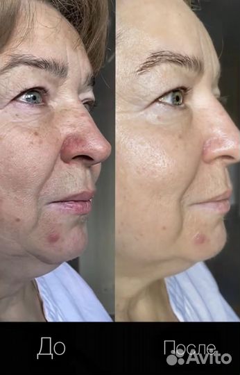 Безоперационная подтяжка лица