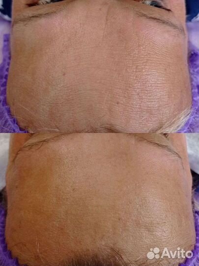 Комбинированная чистка лица