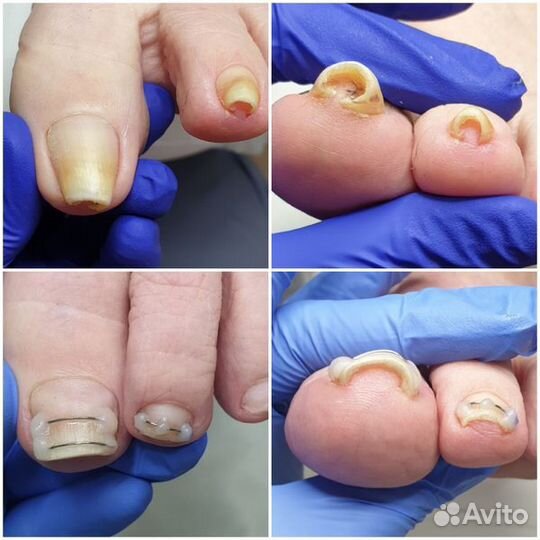 Медицинский педикюр,онихомикоз,онихолизис