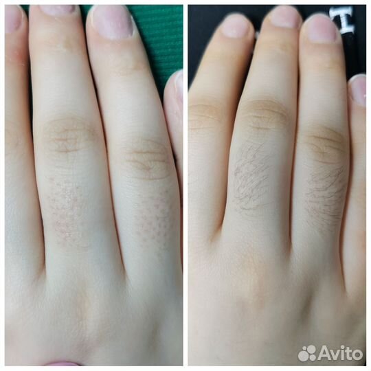 Электроэпиляция