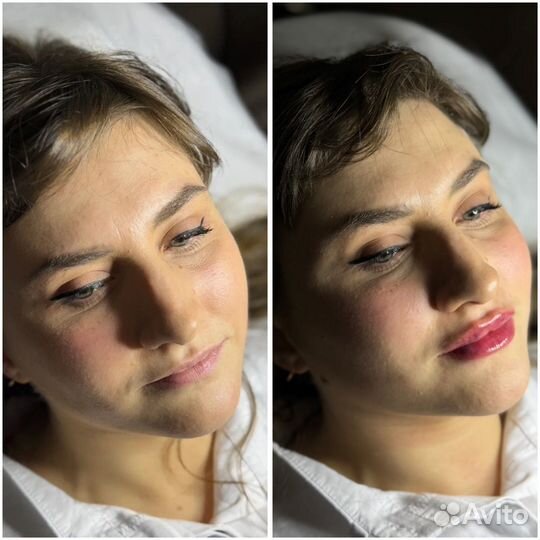 Контурная пластика губ. Увеличение губ