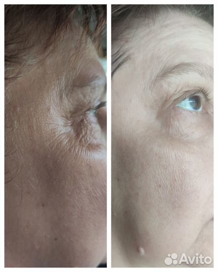 Косметолог чистка лица