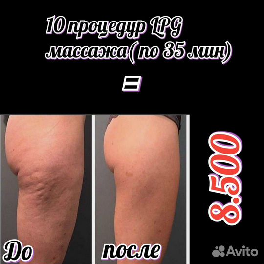 LPG массаж