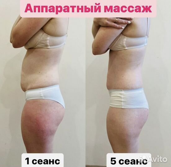 Аппаратный массаж. Антицеллюлитный. Коррекция фигу