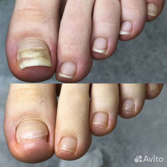 Подологическая обработка стопы, подолог