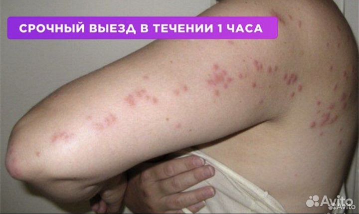 Уничтожение клопов травить тараканов дезинсекция