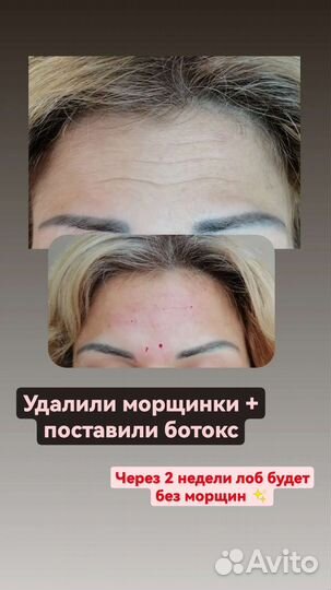 Ботокс, липолитики, мезотерапия, биоревитализация
