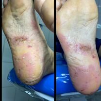 Подолог,Медицинский педикюр,вросший ноготь, Зеленоград