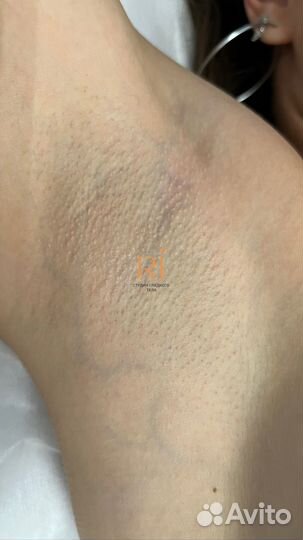 Лазерная эпиляция обучение