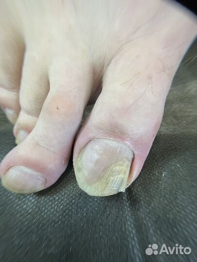 Лечебный педикюр подолог