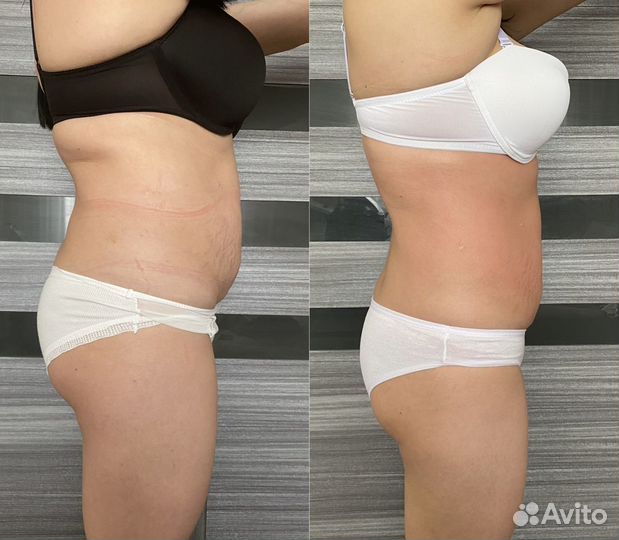 Антицеллюлитный массаж