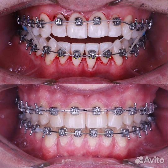 Модель на брекеты