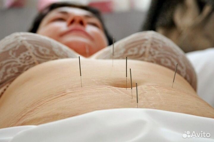 Иглоукалывание