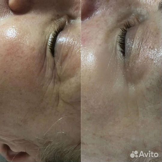 Вакуумный массаж, кавитация, рф+мои ручки