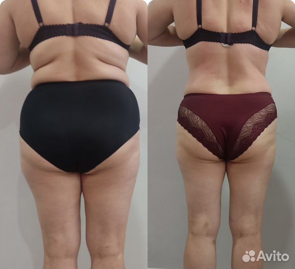 Аппаратный массаж, LPG, коррекция фигуры