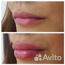 Косметолог Чистка лица, уколы красоты