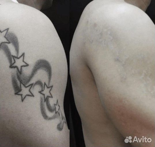 Удаление тату и перманентного макияжа