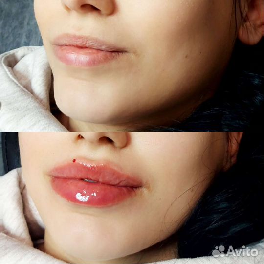 Биоревитализация