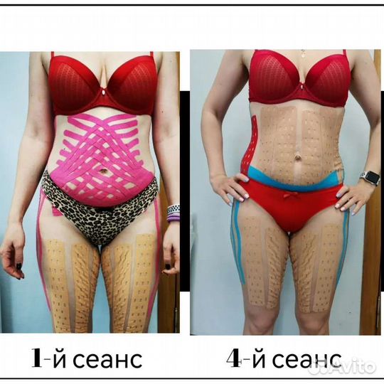 Коррекция фигуры, похудение, тейпирование