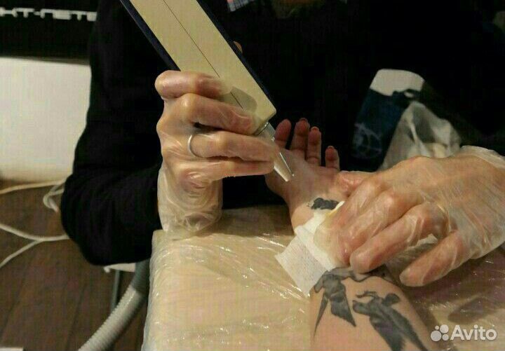 Удаление тату и татуажа