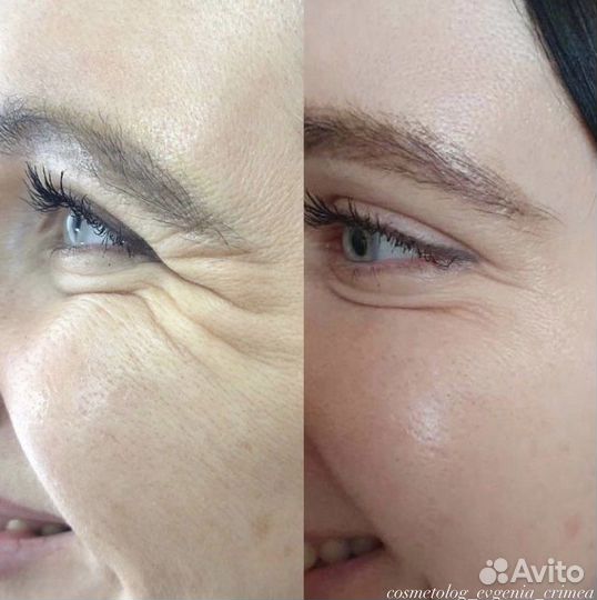 Ботокс для лица