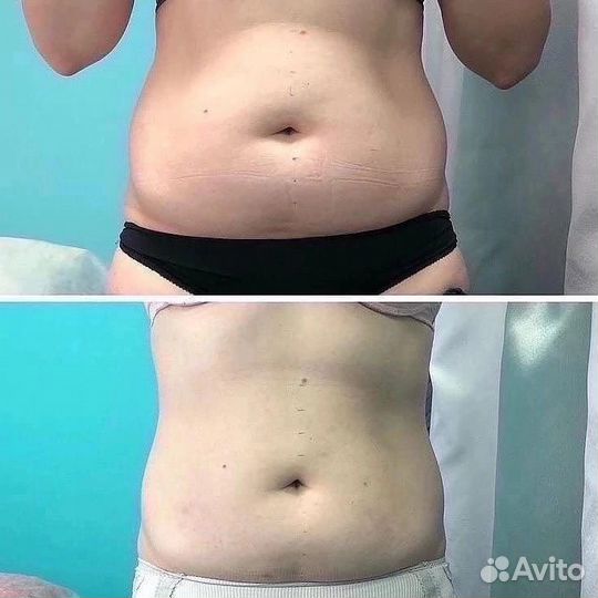 Аппаратный массаж тела