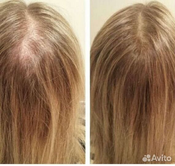 Плазмотерапия