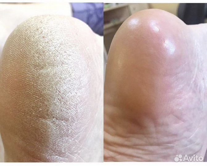 Педикюр, покрытие на ногах