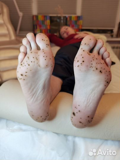 Удаление папилом, родинок, шипиц