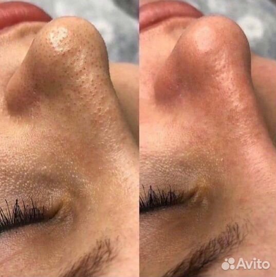 Комплексная Чистка Лица и Биоревитализация