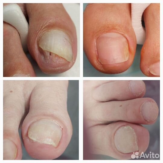 Медицинский педикюр подолог