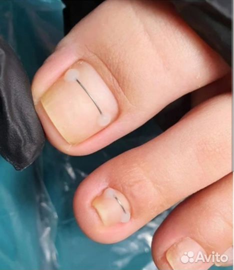 Педикюр лечебный (подология)