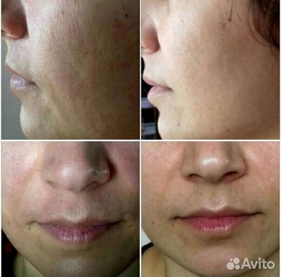 Чистка лица,пилинги