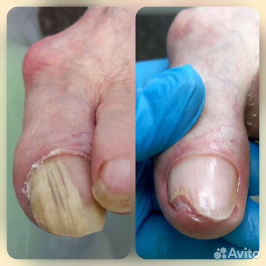 Педикюр подолог