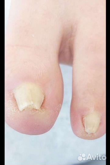 Вросший ноготь
