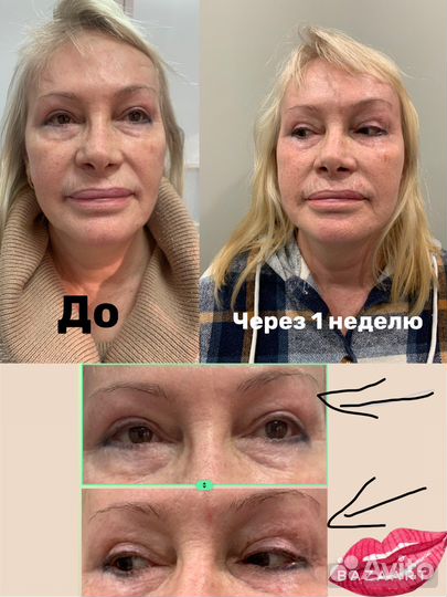 Омоложение Холодной/ Плазмой