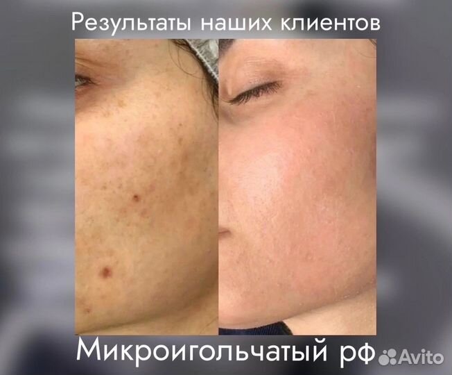 Микроигольчатый RF-лифтинг