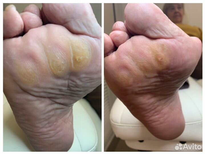 Лечебный педикюр подолог