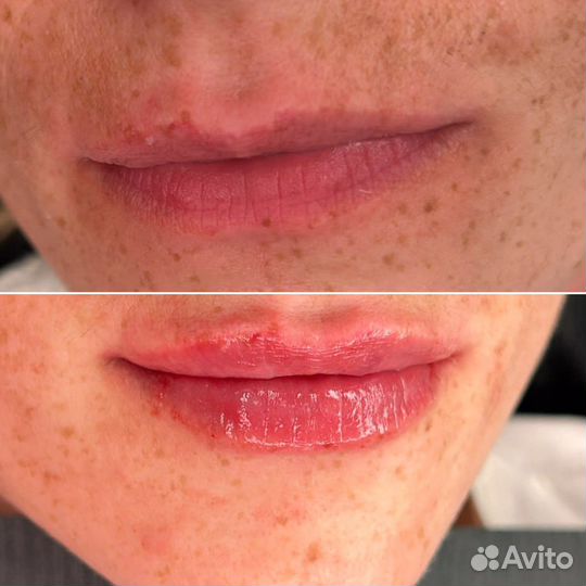 Контурная пластика губ