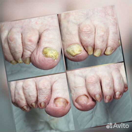 Подология лечение ногтей