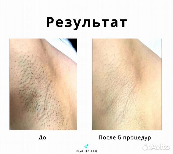 Аппарат для эпиляции lumines Max’One 1200в