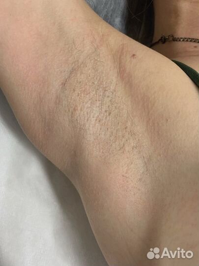 Услуга Электроэпиляции