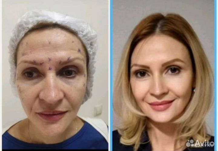 СМАС лифтинг