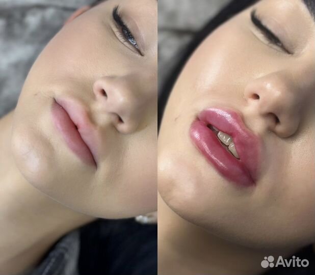 Контурная пластика губ