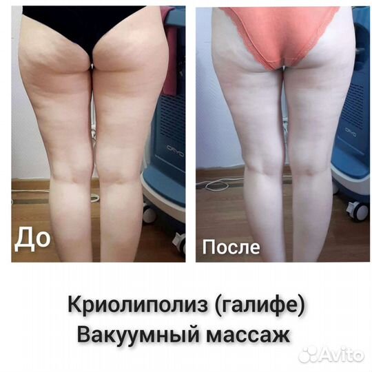 Криолиполиз
