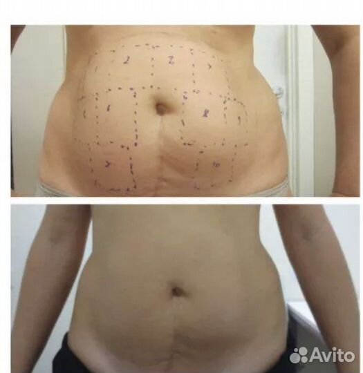 Липосакция без операции. Liposonix