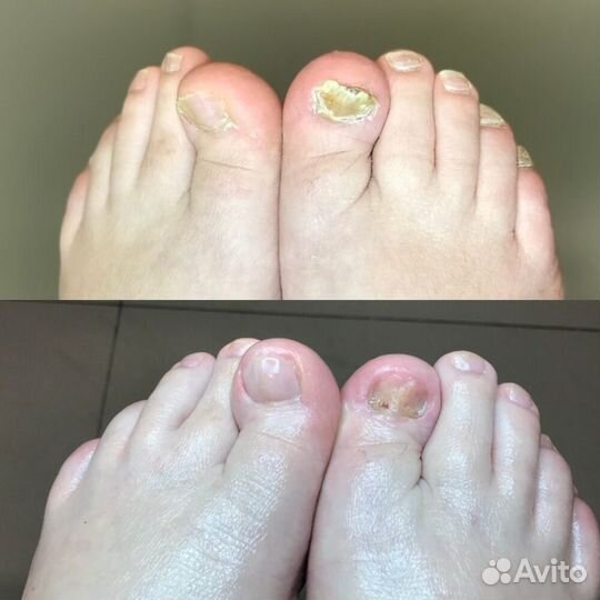 Педикюр лечебный